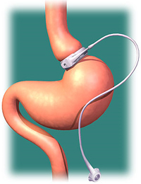 Gastric banding surgery
