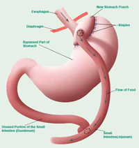 Gastric bypass surgery