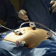 Bariatric Surgery For Weight Loss