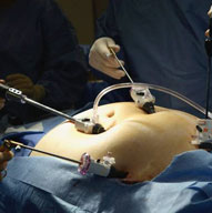 Gastric Bypass Weight Loss Surgery