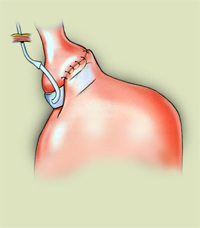 Stomach stapling surgery