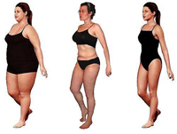 Weight Loss Surgery Stories